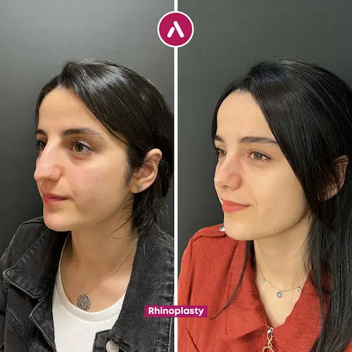 Rhinoplasty before after #1