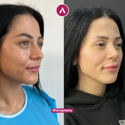 Rhinoplasty before after #2