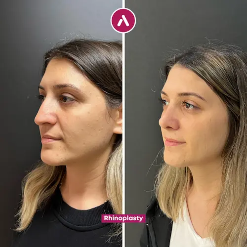 Rhinoplasty before after #3