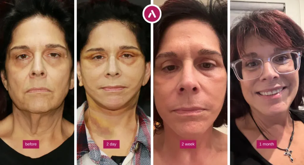 Deep plane facelift recovery timeline day by day, showing before, day 2 bruising, week 2 healing, and 1 month results.