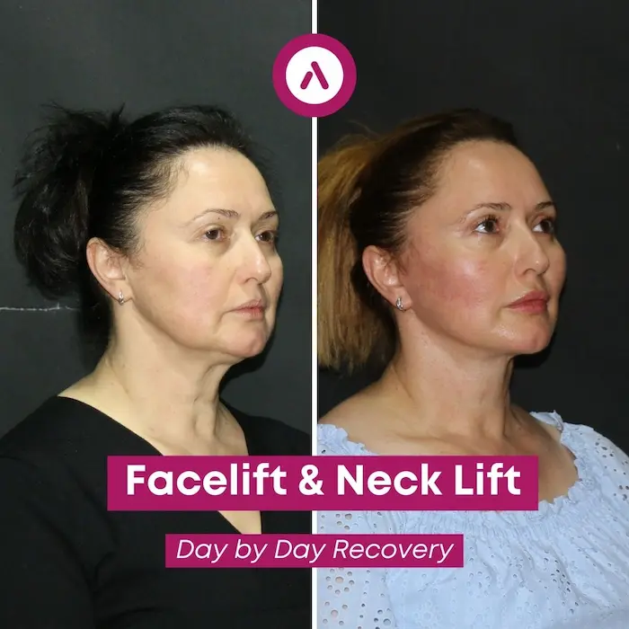 deep-plane-facelift-result-1