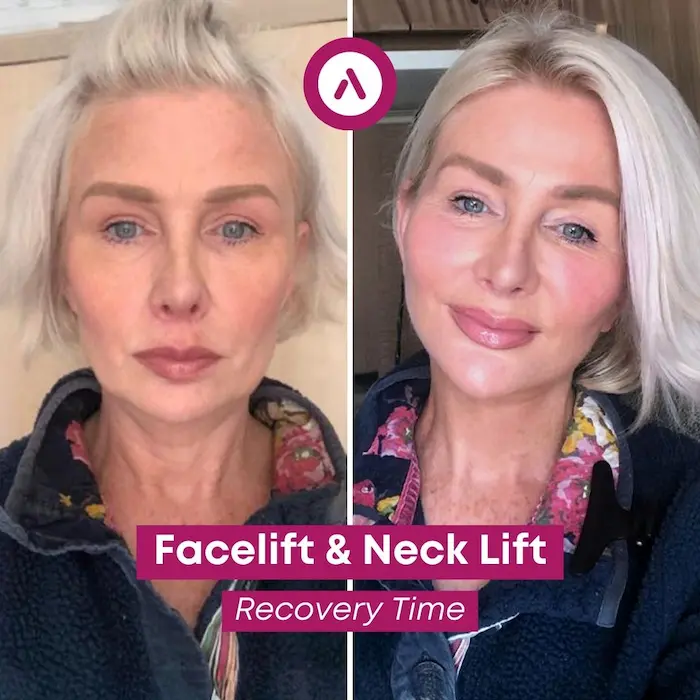 deep-plane-facelift-result-2