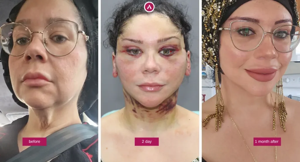 Deep Plane Facelift Vorher-Nachher: Vergleich vor der Operation, 2 Tage danach und 1 Monat später mit sichtbarem Heilungsverlauf.