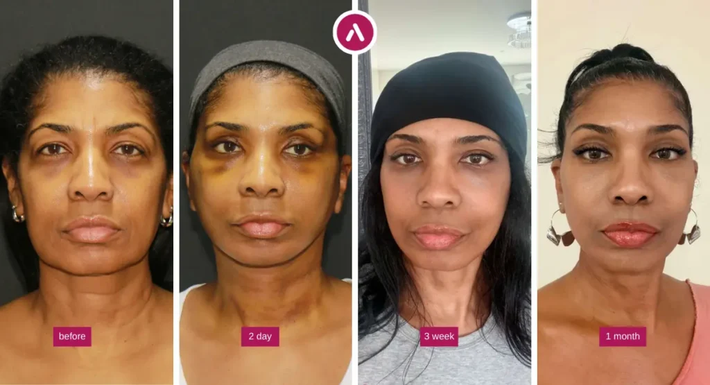 Dämmerschlaf-Facelift Vorher und Nachher: Bildreihe mit Ausgangsbefund sowie Ergebnissen nach 2 Tagen, 3 Wochen und 1 Monat.