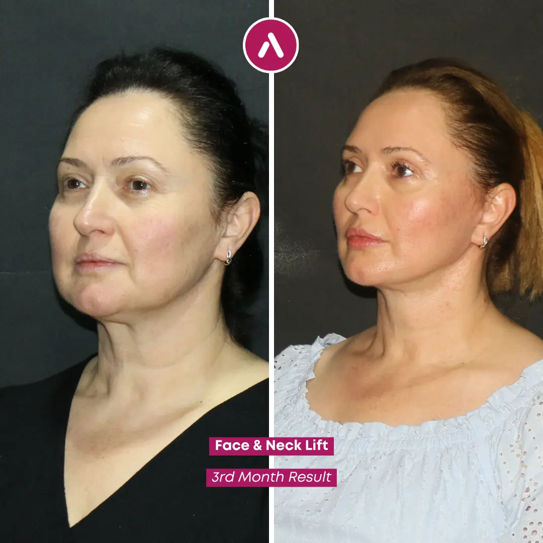 Before and after comparison of a Face and Neck Lift surgery at AKM Clinic in Turkey, showing natural 3rd-month results on a female patient with defined jawline and neck tightening.