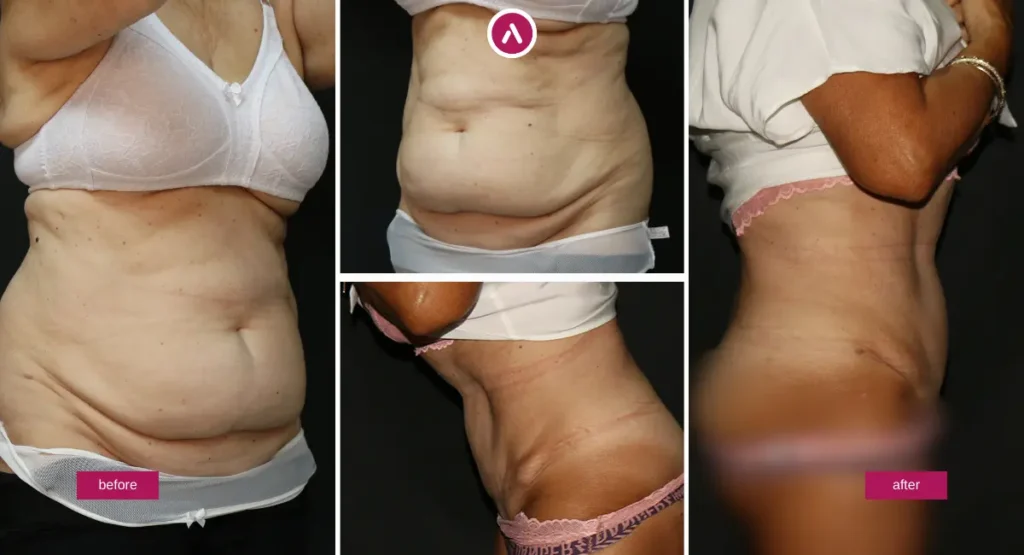 360 Body Lift recovery timeline comparison showing abdominal contour improvement and belt-line scar healing progression.