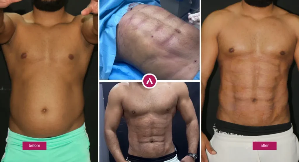 Abdominal Etching before and after photo showing improved abdominal definition after ab etching body contouring.