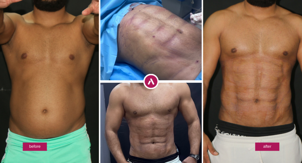 Abdominal etching before and after results showing improved six-pack definition and torso contour.