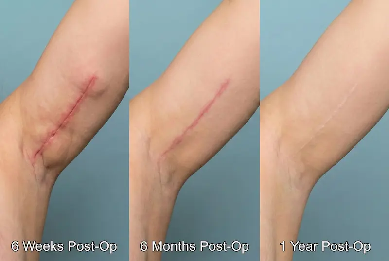 Arm Lift (Brachioplasty) scar timeline showing incision healing at 6 weeks post-op, 6 months post-op, and arm lift scars after 1 year.