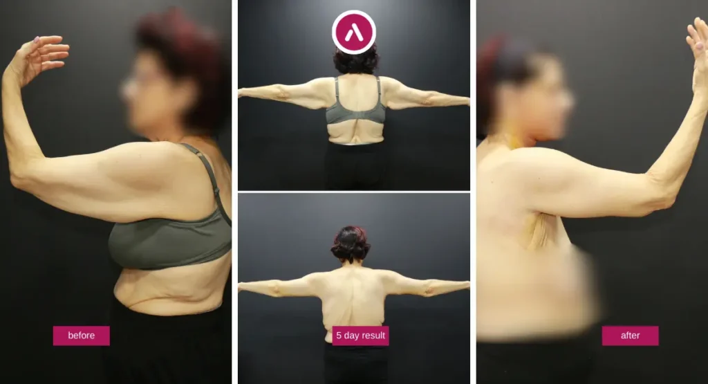 Awake Arm Lift Before and After showing upper-arm contour improvement 5 days after surgery at AKM Clinic.