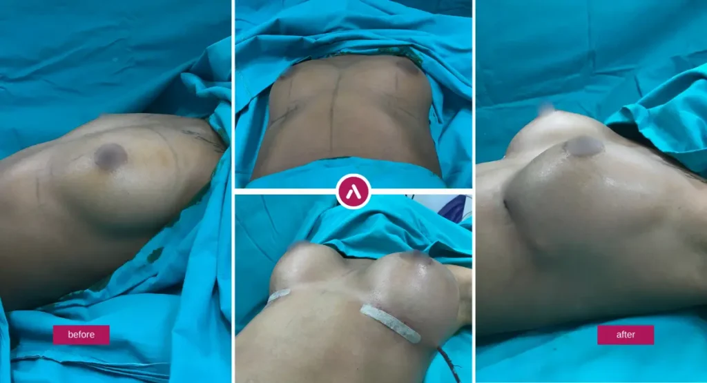 Awake Breast Augmentation Before and After showing breast implant results under local anesthesia.