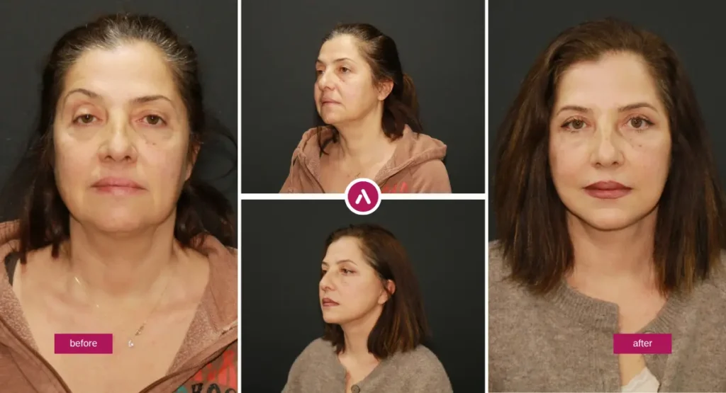 Awake Deep Plane Facelift Before and After photos showing natural facial rejuvenation and improved jawline definition.