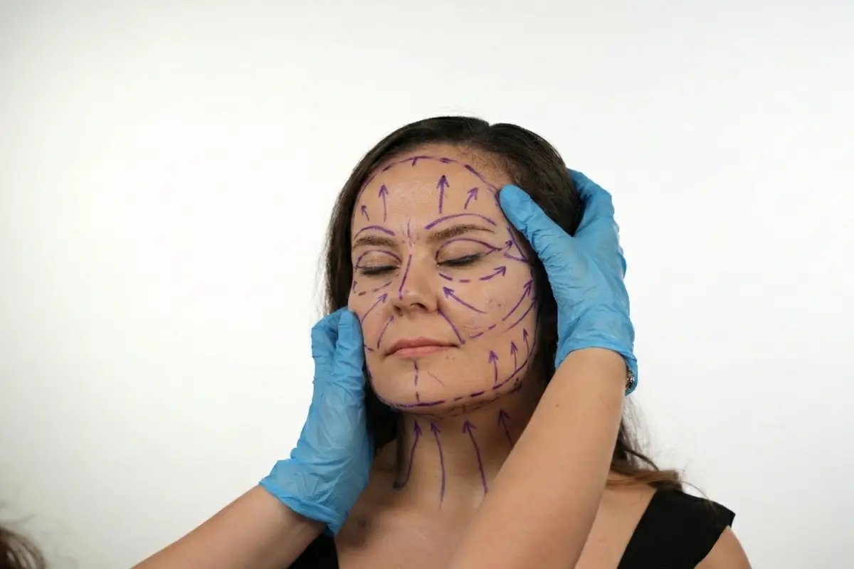 Patient with pre-op facelift markings and arrows on face and neck while a clinician wearing blue gloves assesses positioning for an Awake Deep Plane Facelift.