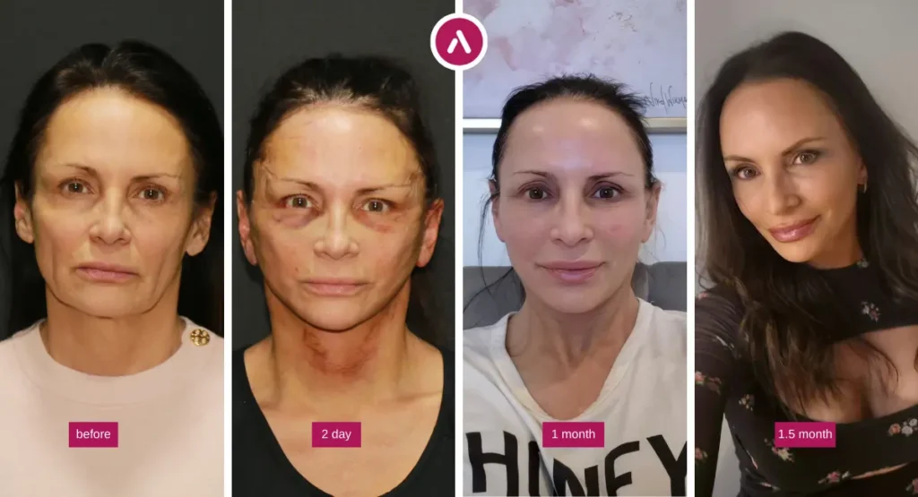 Awake facelift before and after 50 year old woman showing before, 2-day, 1-month, and 1.5-month recovery results