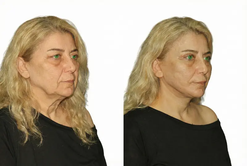awake facelift before and after 60 year old woman, oblique side view comparison showing lifted jawline, tighter neck and smoother midface