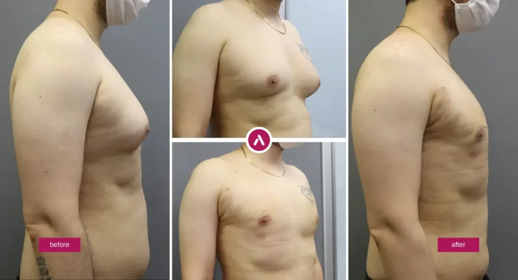 Awake gynecomastia before and after photos showing flatter male chest contour after surgery.