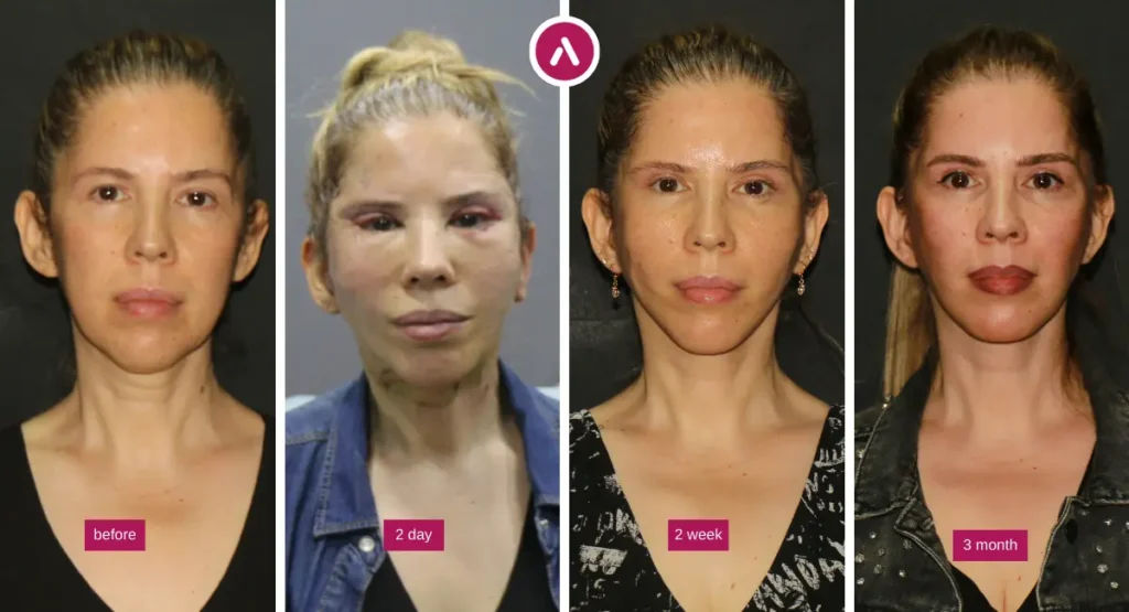 Awake mini facelift before-and-after sequence: before, 2 days, 2 weeks, and 3 months showing jawline refinement.