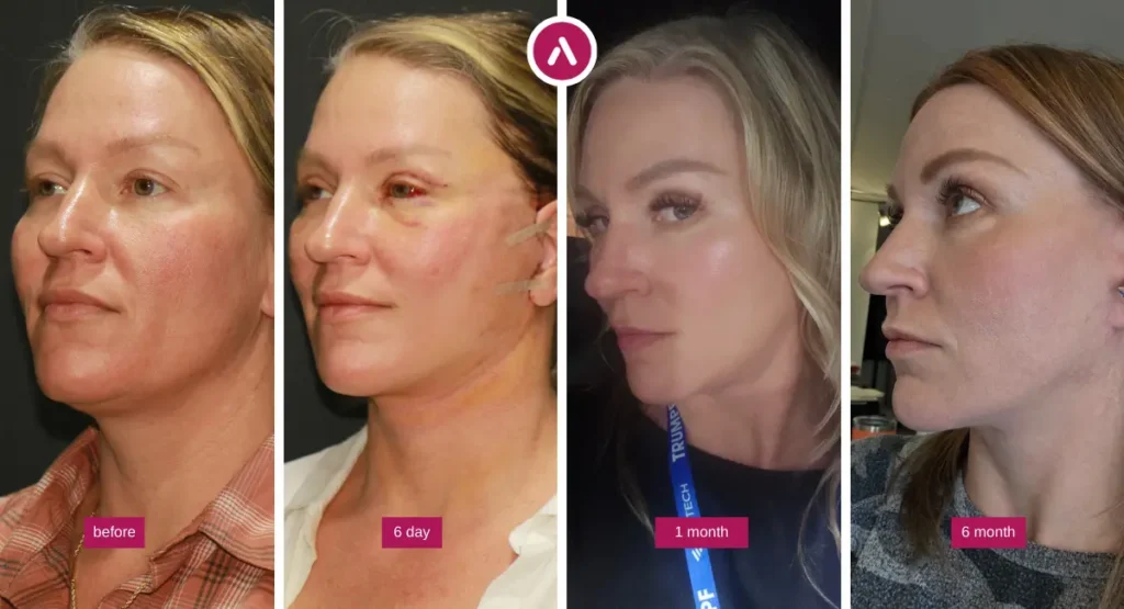 Awake neck lift before and after recovery timeline showing neck and jawline improvement from before surgery to 6 days, 1 month, and 6 months after treatment.