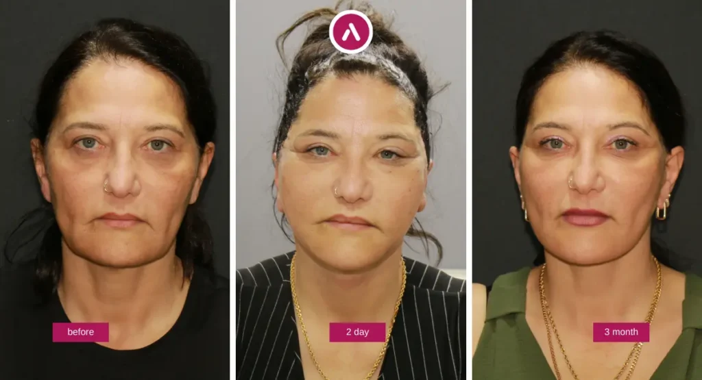 Awake neck lift before-and-after photos showing appearance at before, 2 days post-op, and 3 months follow-up.