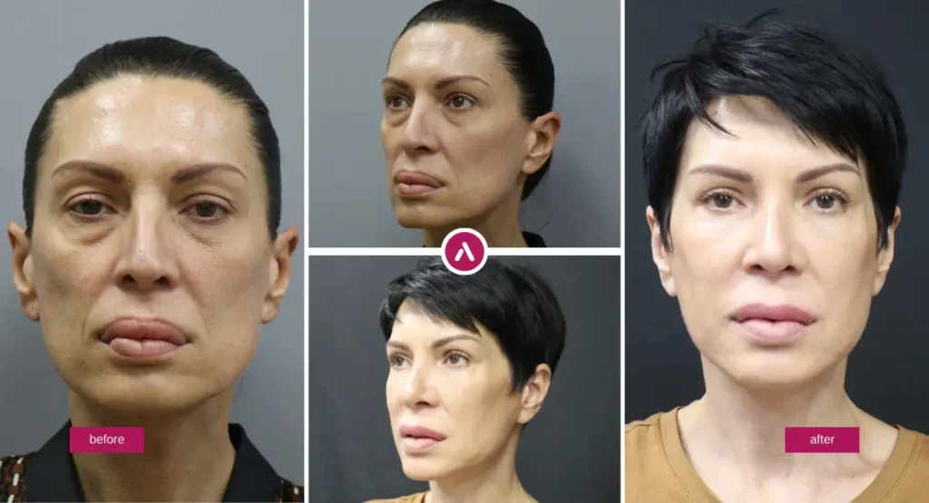 Blepharoplasty before and after photos showing natural eyelid surgery results with a refreshed upper and lower eye appearance.