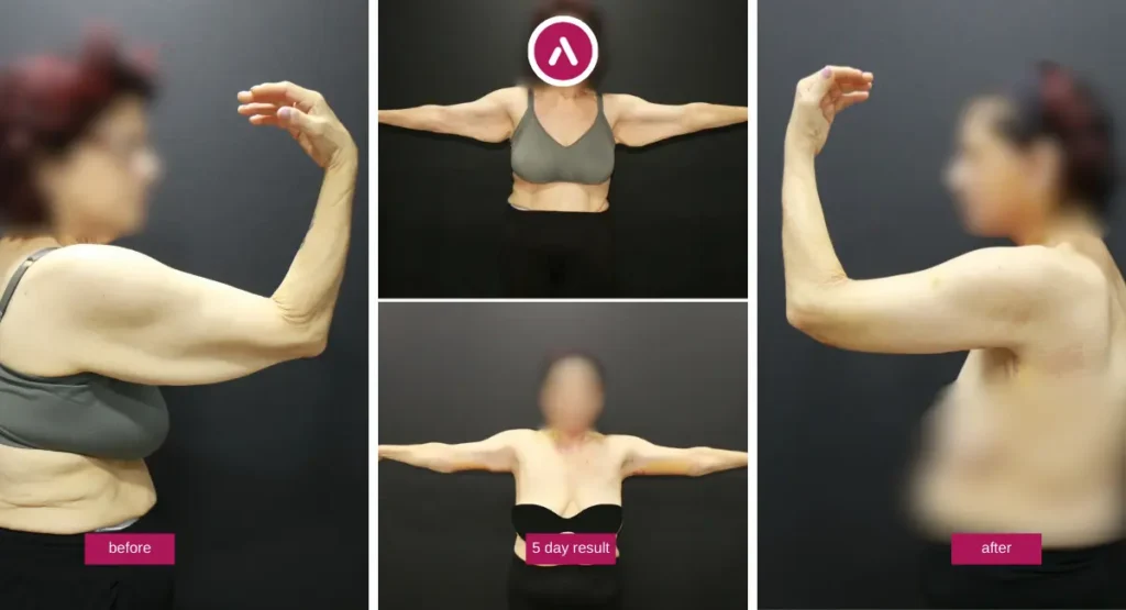 Brachioplasty before and after photos showing upper-arm skin reduction and early 5-day arm lift result.