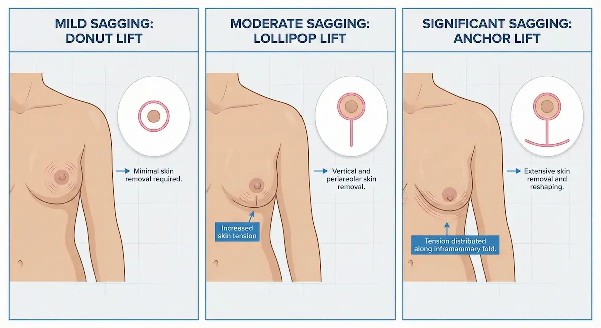 Diagram showing donut, lollipop, and anchor breast lift incision patterns matched to mild, moderate, and significant sagging.