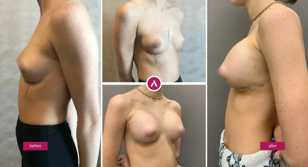 Breast lift with implants before and after photo showing lifted position and restored volume/projection.