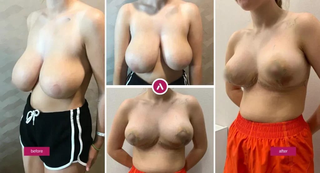 Breast Reduction before and after photo showing reduced breast volume and a more lifted shape after reduction mammoplasty.