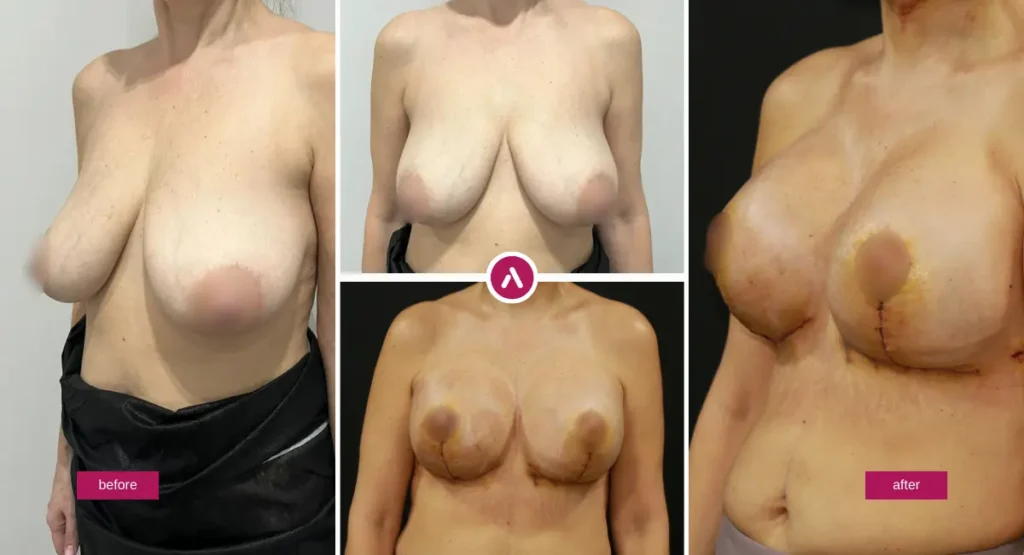 Breast Reduction before and after collage showing reduced volume and a more lifted, proportionate contour.
