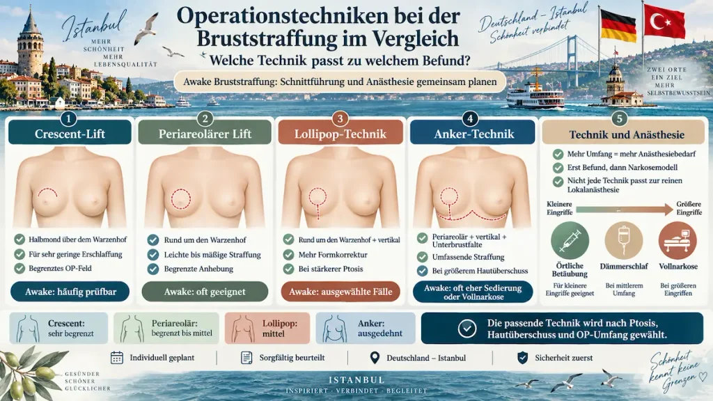 Bruststraffung ohne Vollnarkose: Infografik zu Crescent-Lift, periareolärem Lift, Lollipop- und Anker-Technik