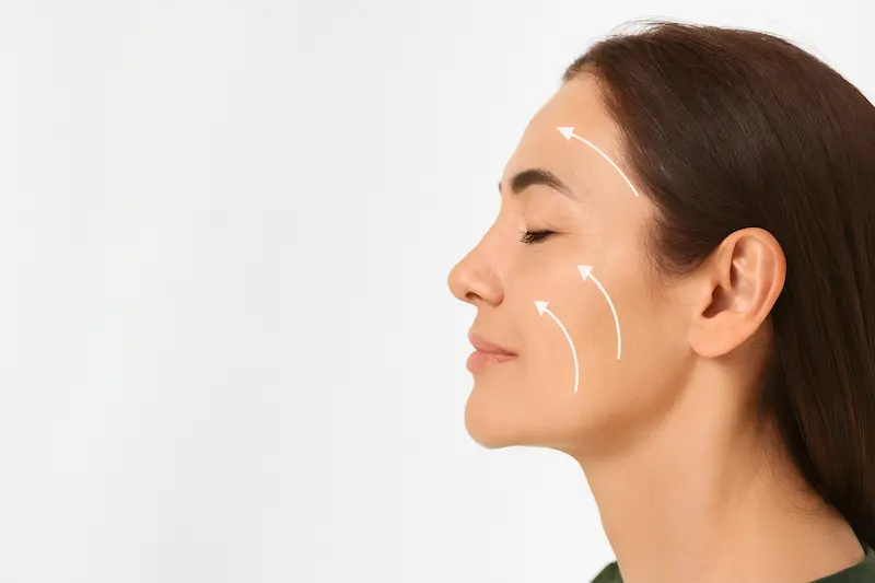 Right-profile view of a middle-aged woman with facelift lift arrows on her cheek against a white background, illustrating deep plane facelift in turkey cost and planning.