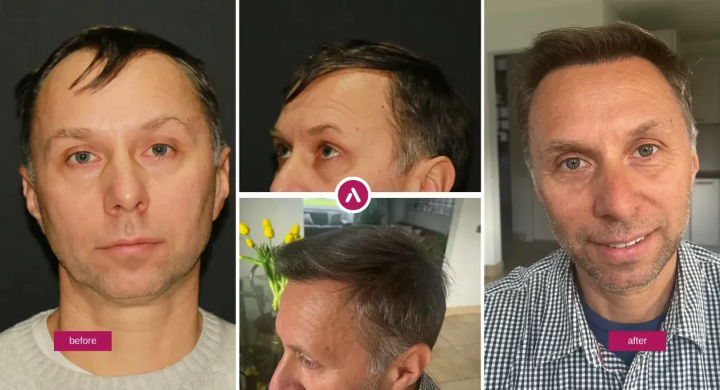 DHI Hair Transplant before and after photos showing improved hairline coverage and density from multiple angles.