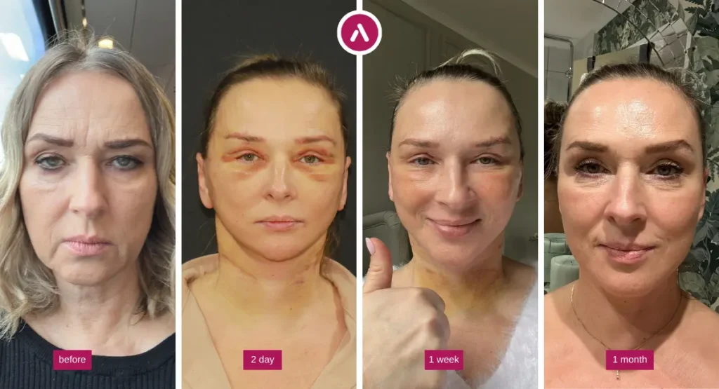 Endoscopic temporal brow lift recovery photos: before, day 2 bruising, week 1 healing, and month 1 refreshed appearance.