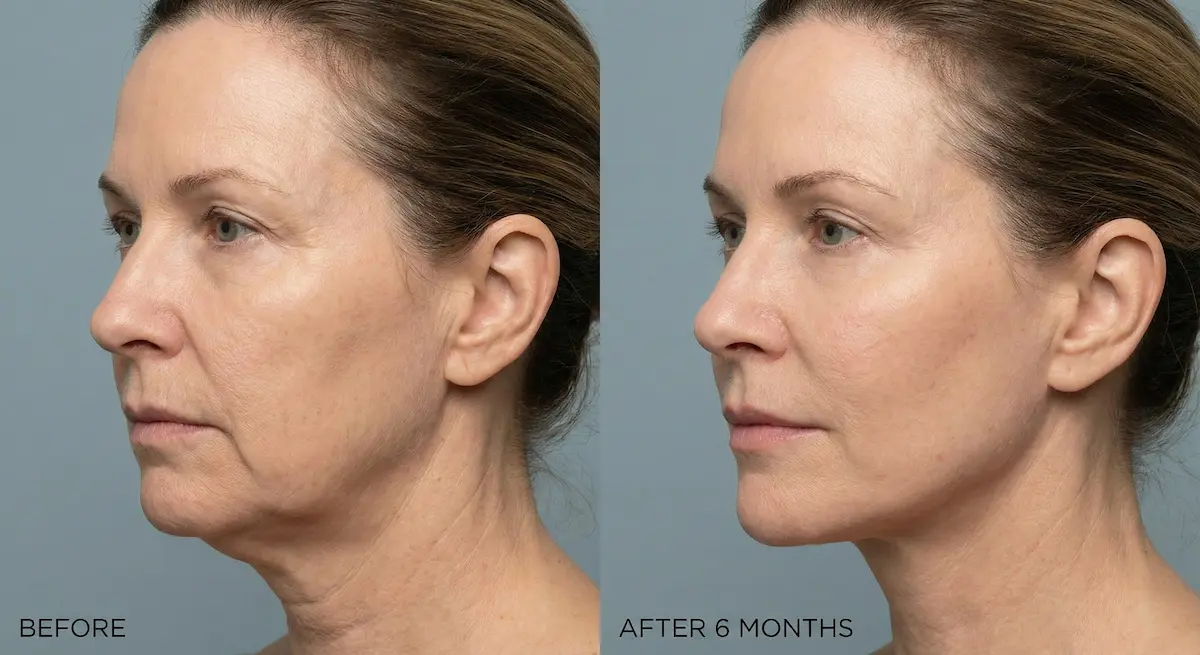 Before and after 6 months profile photo showing improved jawline and neck contour after facelift.