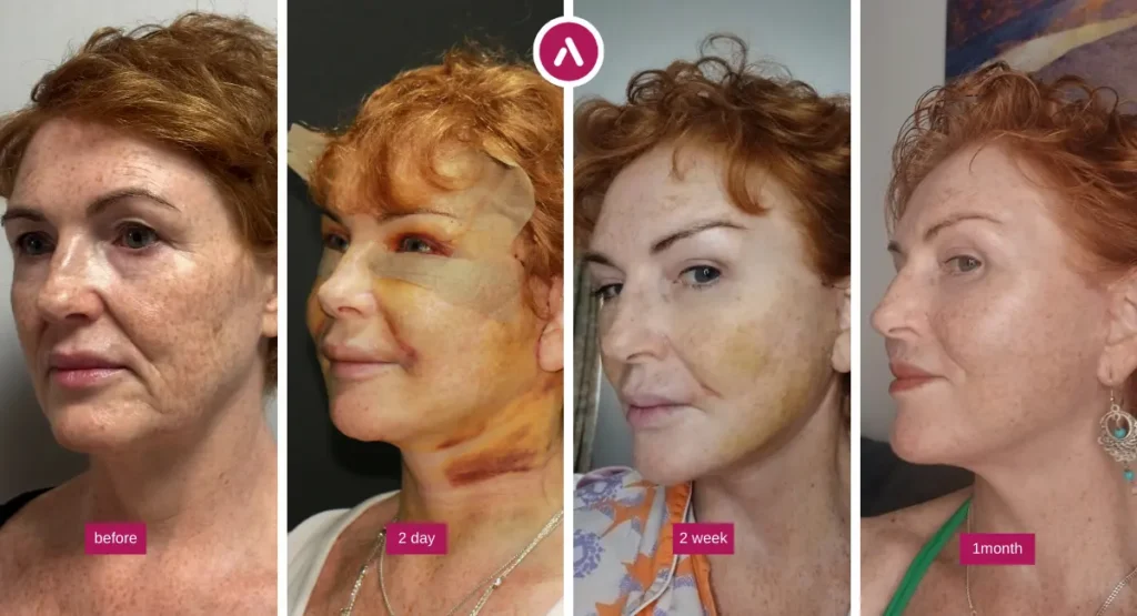 Facelift recovery day by day photo series showing before surgery, 2 days, 2 weeks and 1 month with swelling and bruising improving over time.