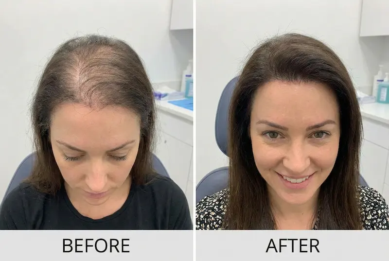 Female Hair Transplant before and after comparison showing improved hairline coverage and fuller part-line density after treatment.