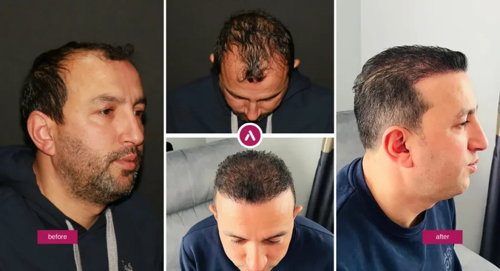 FUE Hair Transplant before and after collage showing improved hairline and increased scalp coverage from side and top views.