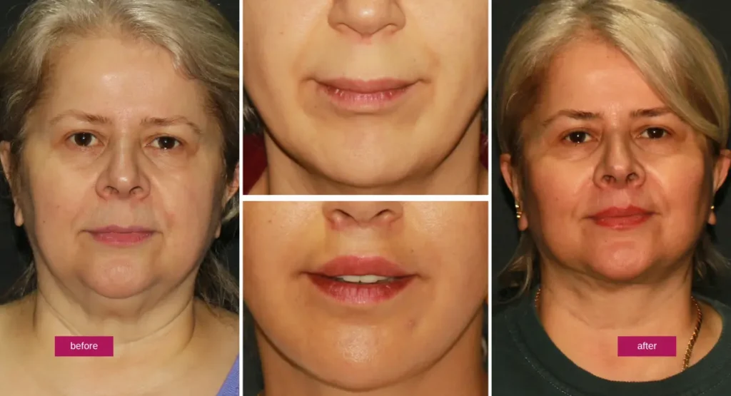 Lip lift before and after photo showing upper lip elevation, improved pink lip visibility, and natural facial proportion.