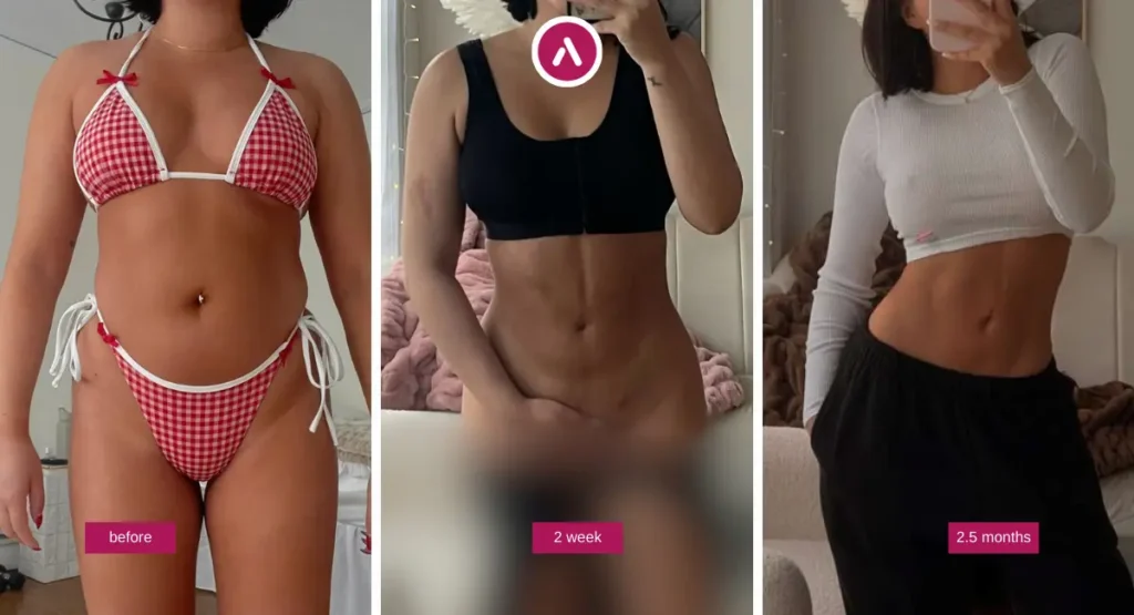 Liposuction before and after timeline showing abdomen and waistline contour: before, 2 weeks, and 2.5 months.