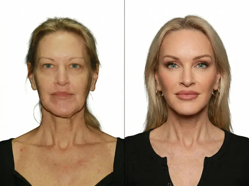 Mid Face Lift surgery before and after photo showing improved cheek contour and a smoother lower eyelid–cheek junction.