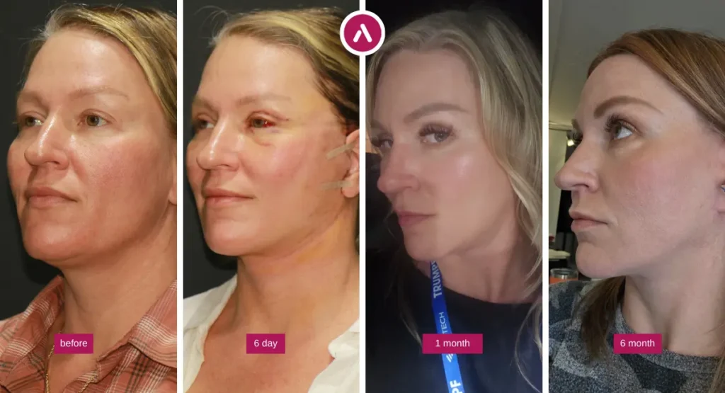 Midface Lift Before and After photo timeline showing before, 6-day, 1-month and 6-month facial rejuvenation results.
