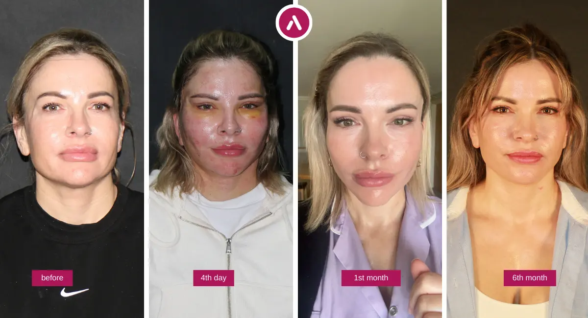 Mini Facelift before and after collage showing before, day 4 swelling, 1 month healing and 6 months refined result.