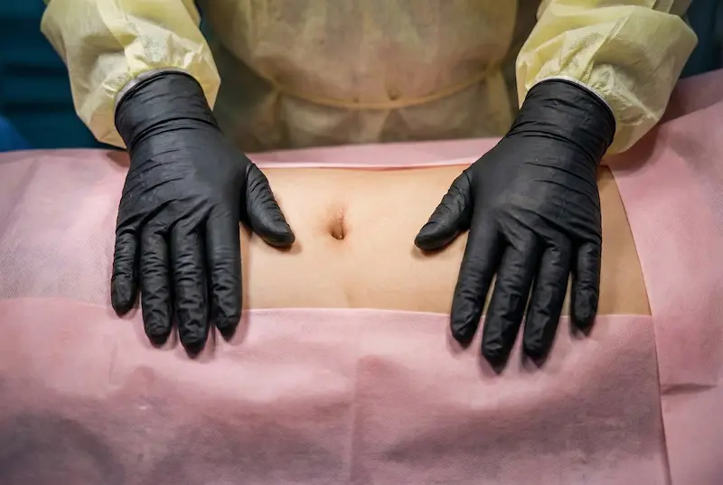 “Mini tummy tuck vs liposuction: surgeon hands assessing lower abdomen to illustrate skin tightening vs fat removal options.”