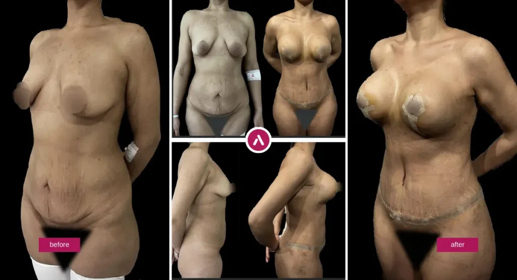 Mommy Makeover Before and After photo showing abdominal contouring, breast restoration, tummy tuck results, and body shape improvement.