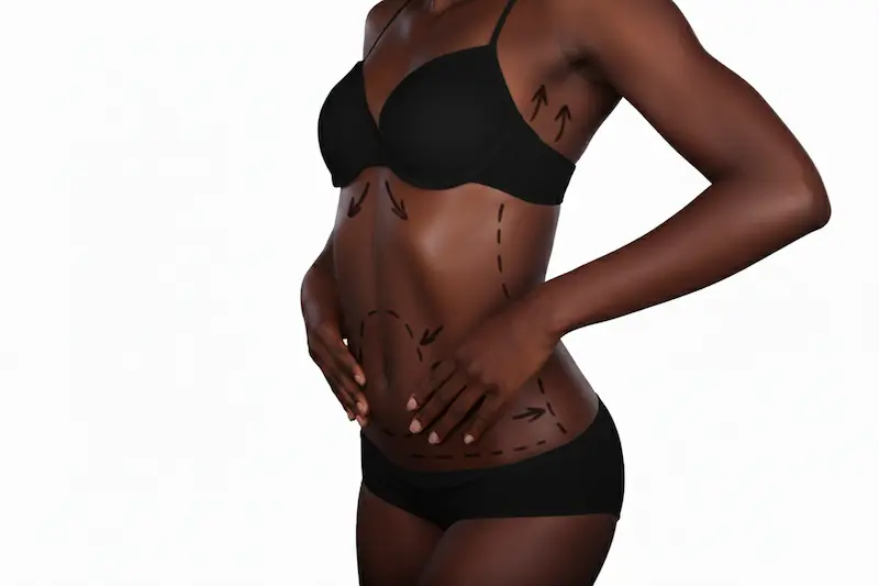 Woman in black underwear with surgical markings on abdomen and waist illustrating mommy makeover inclusions before surgery