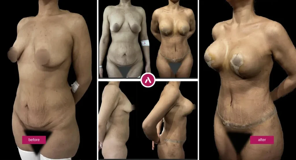 Mommy Makeover ohne Vollnarkose: Vorher-Nachher-Aufnahmen von Bauch- und Brustkorrektur mit sichtbarer Körperkonturierung.