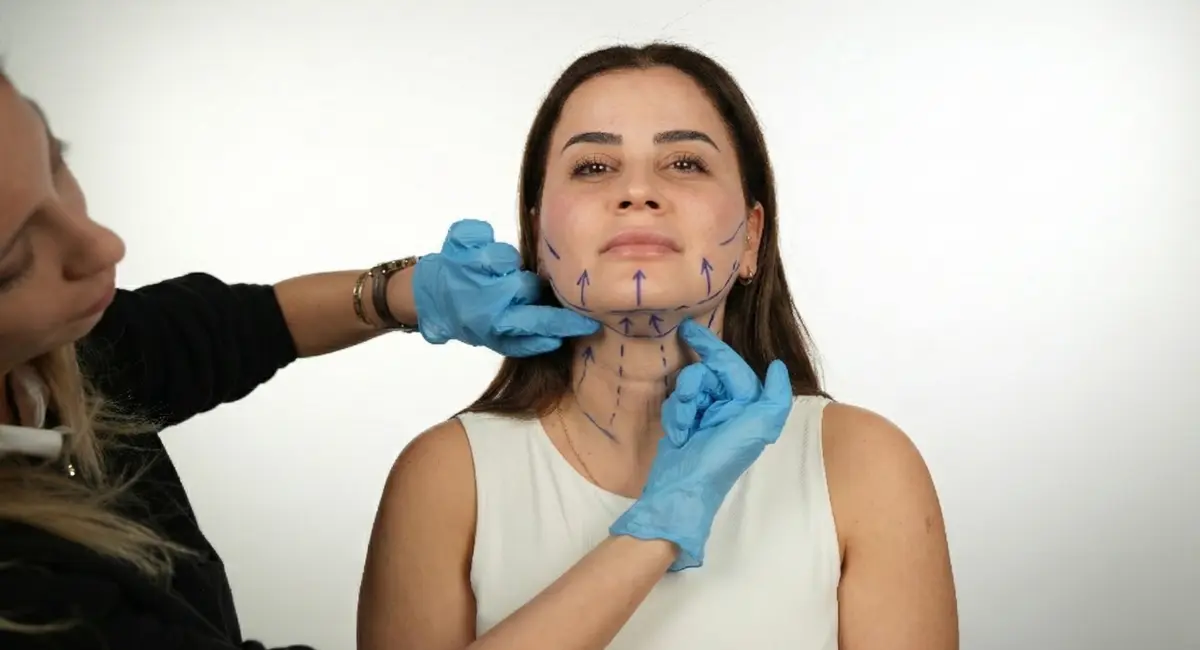 Clinician wearing blue gloves assessing a woman’s chin and neck with pre-operative neck lift markings and arrow vectors drawn on the skin.
