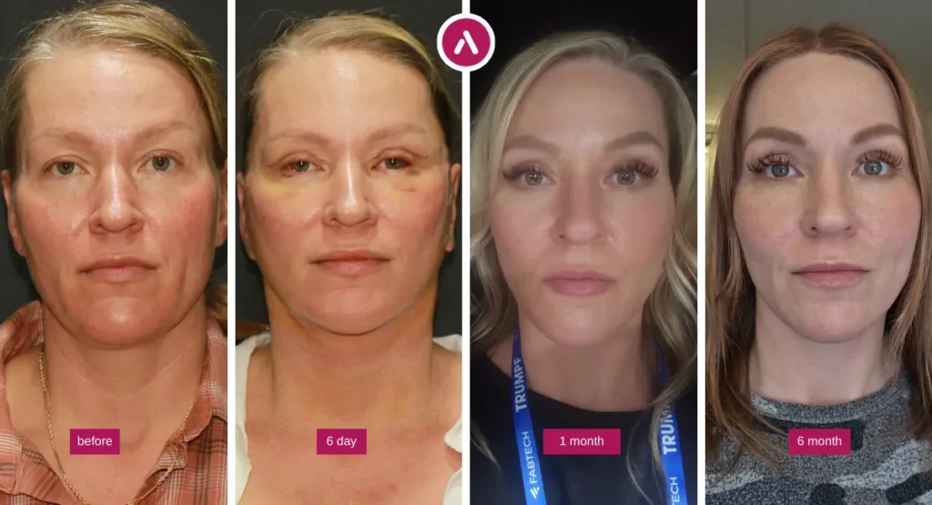 Revision Facelift before and after photo sequence showing pre-op baseline, day 6 early healing, 1-month settling, and 6-month result.