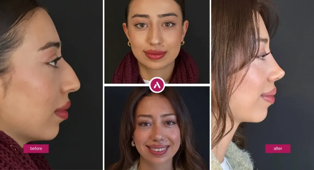 Rhinoplasty (Nose Job) before-and-after photo collage showing front and side views with a smoother bridge and refined nasal tip for a natural result.