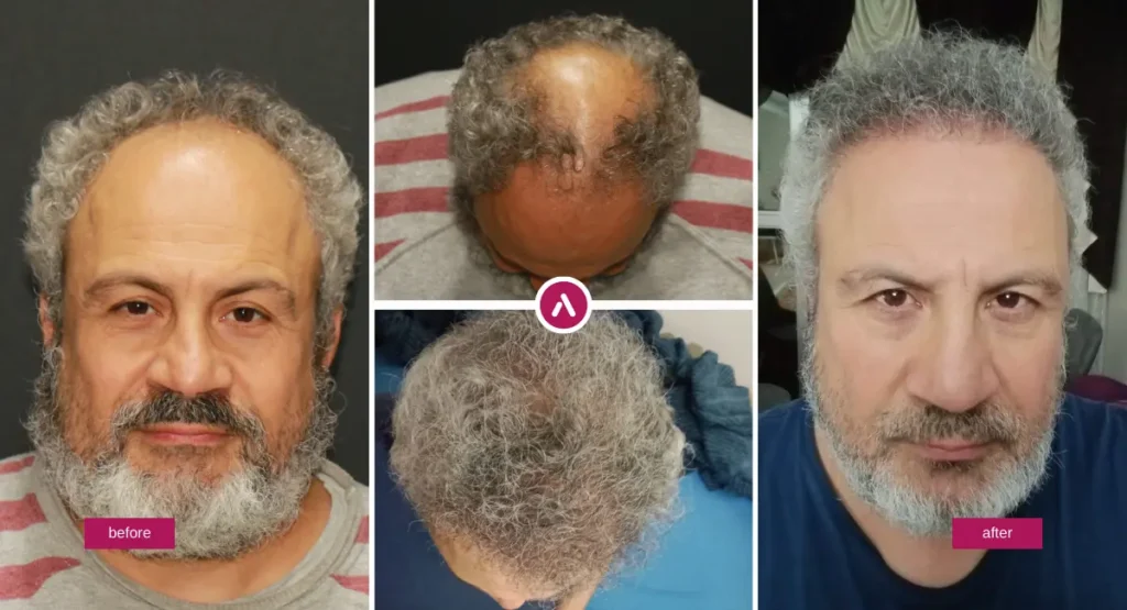 Sapphire FUE before and after hair transplant result showing improved hairline and scalp coverage.
